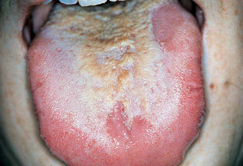 amaiture nude pics pictures of hairy tongue